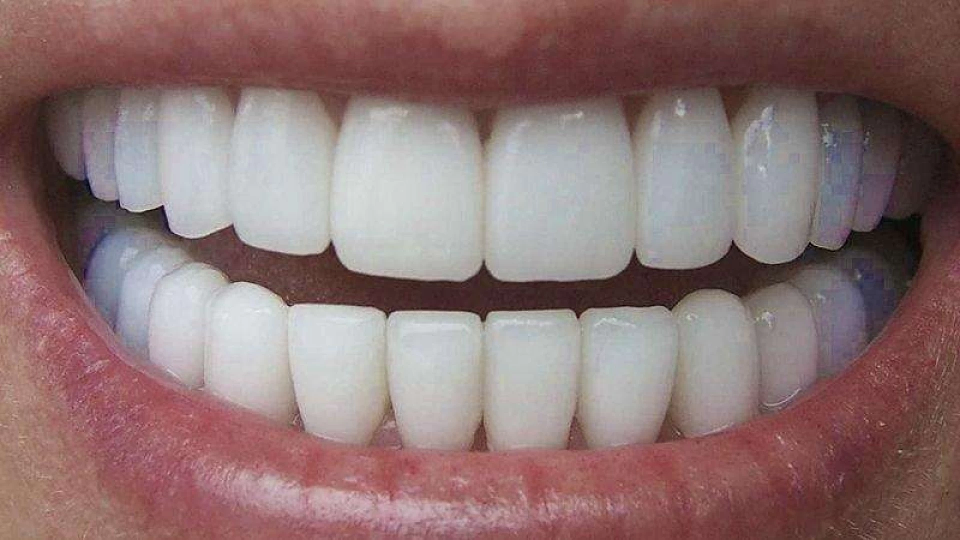 Dente em Porcelana 