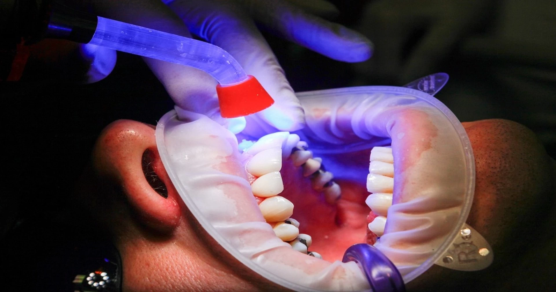 Terapia a Laser